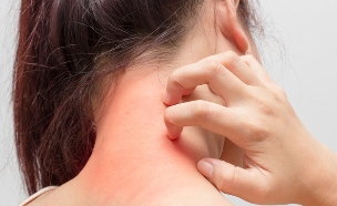 אטופיק דרמטיטיס (צילום: Shutterstock/)